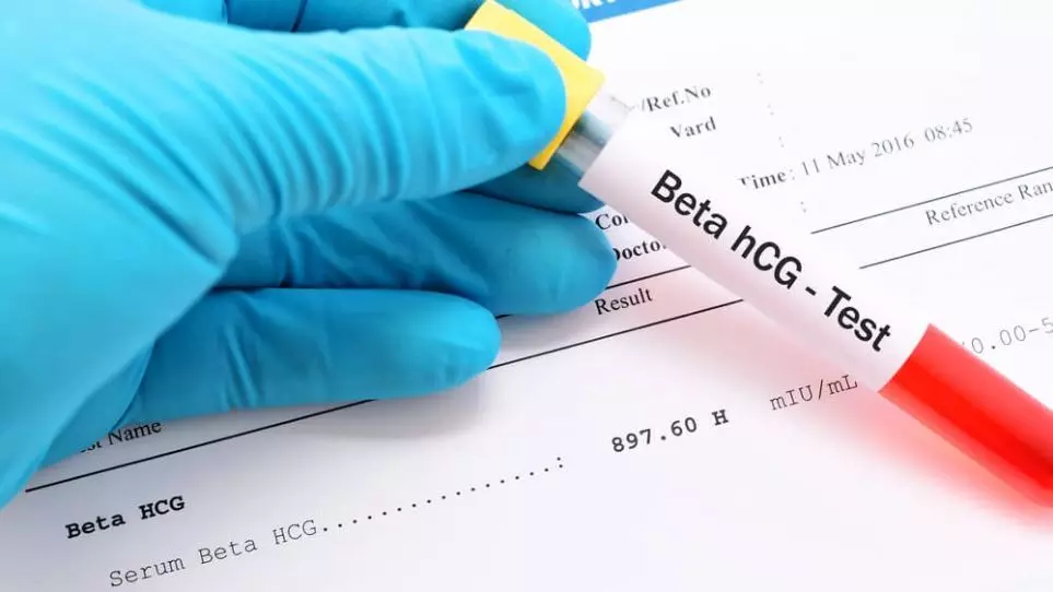 تست Beta HCG چیست بهمراه توضیحات کامل
