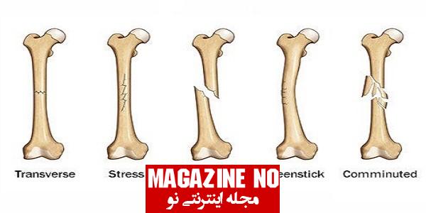 شکستگی (Fracture) + بررسی انواع شکستگی‌ها در استخوان