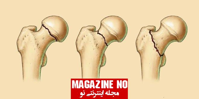 شکستگی (Fracture) + بررسی انواع شکستگی‌ها در استخوان