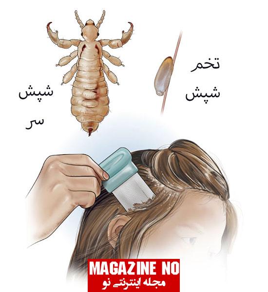 شپش (Louse) + علائم، نشانه‌ها و پیشگیری از آلودگی به شپش