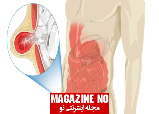 فتق فمورال (Bubonocele) + علائم، نشانه‌ها و درمان فتق فمورال