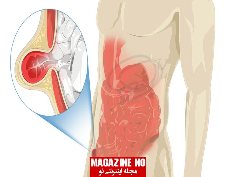 فتق فمورال (Bubonocele) + علائم، نشانه‌ها و درمان فتق فمورال