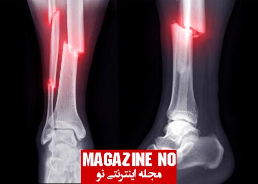 شکستگی (Fracture) + بررسی انواع شکستگی‌ها در استخوان