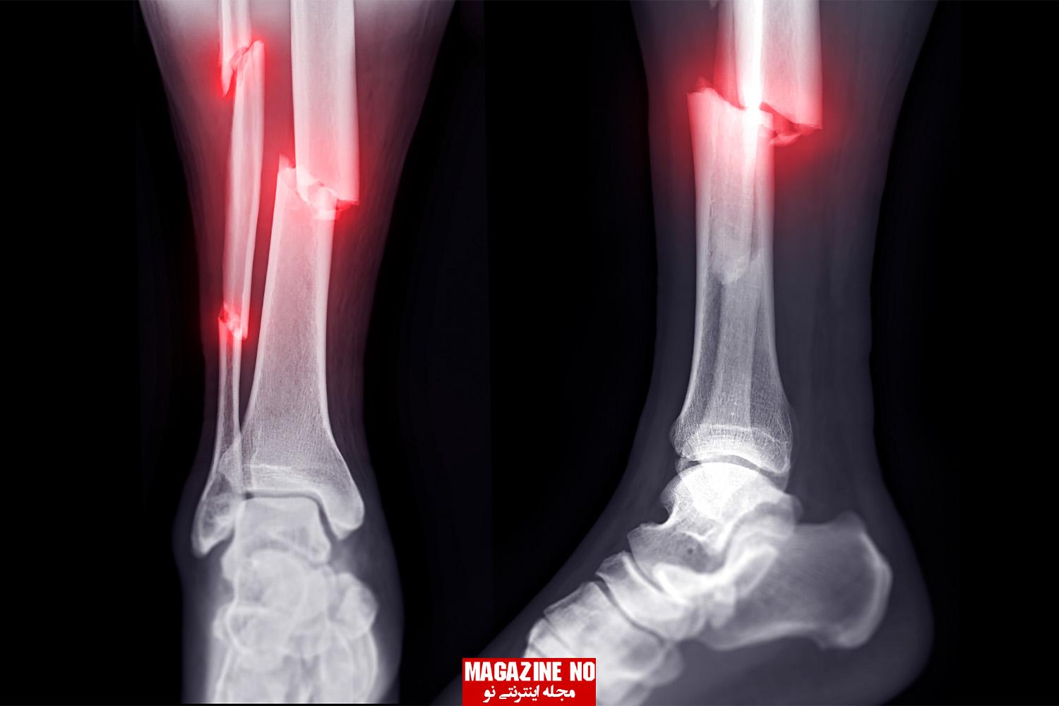 شکستگی (Fracture) + بررسی انواع شکستگی‌ها در استخوان