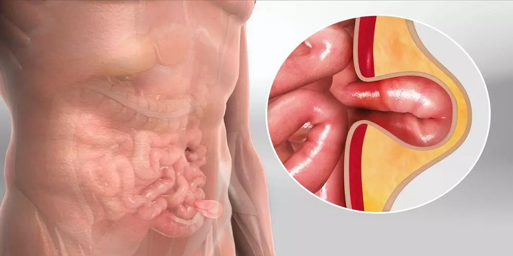 فتق فمورال (Bubonocele) + علائم، نشانه‌ها و درمان فتق فمورال 