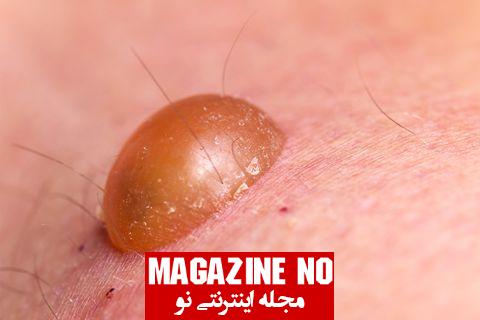 سیفلیس (Syphilis)- راه انتقال بیماری، علائم، پیشگیری و درمان