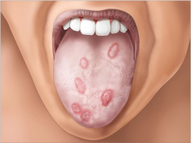 سیفلیس (Syphilis)- راه انتقال بیماری، علائم، پیشگیری و درمان