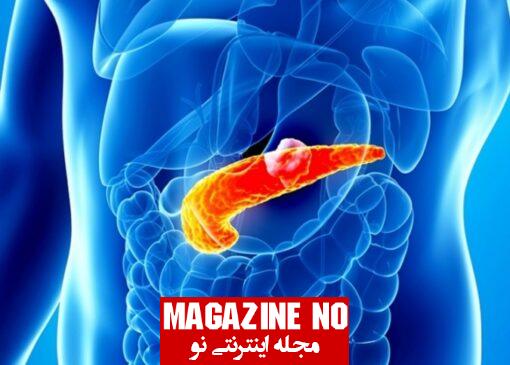 سنگ کیسه صفرا (Gallstone) : علل، علائم، تشخیص و درمان