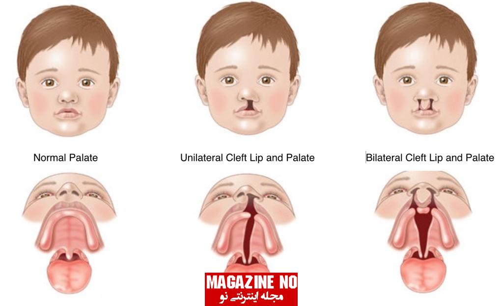 سقف دهان یا کام- شکاف لب و کام در نوزادان چیست؟