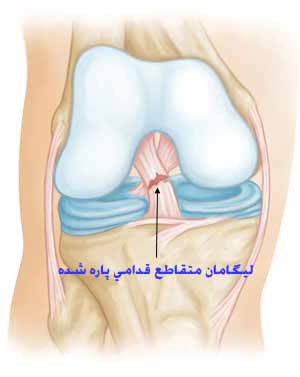 پارگي رباط صليبي قدامي؛ شايعترين آسيب رباطي زانو