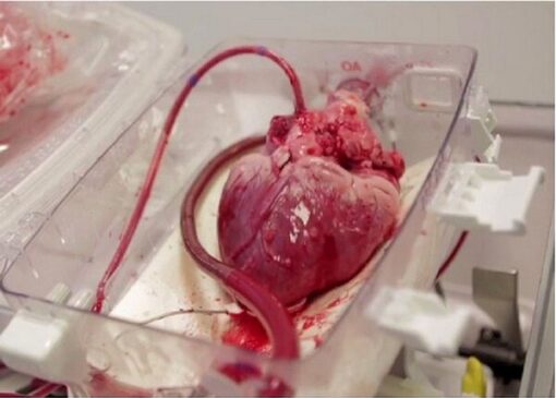 انتقال قلب برای پیوند به نوجوان ۱۵ ساله با اورژانس هوایی